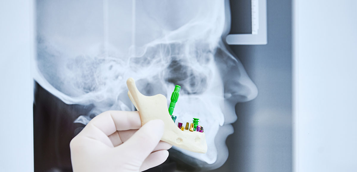 Implantes dentales sin hueso qué soluciones hay Clínica Dental