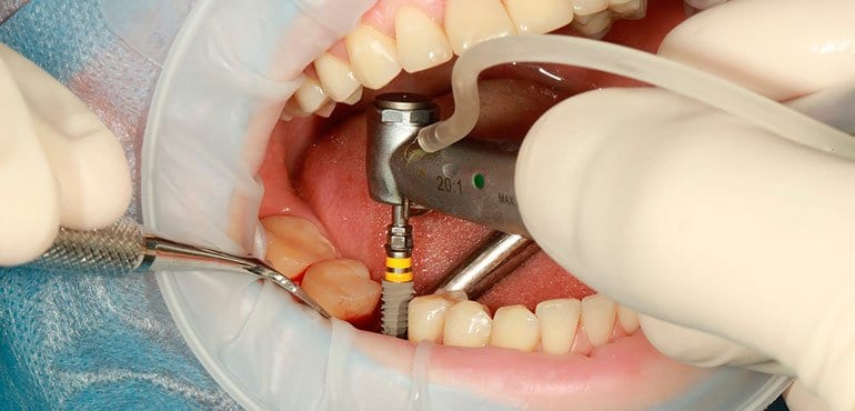 Características y tipos de implantes dentales. Resolvemos dudas ...