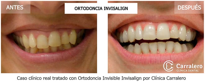 antes-despues-invisalign