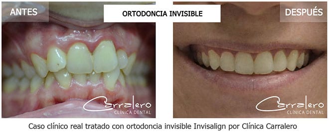 invisalign-antes-despues