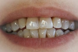 sonrisa-inicial