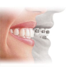 sonrisa invisalign