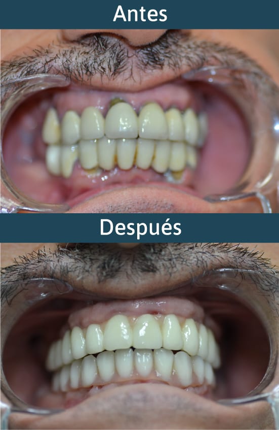 antes-después-implantes