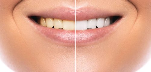beneficios del blanqueamiento dental