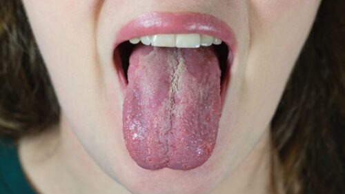 es grave la candidiasis oral como eliminarla
