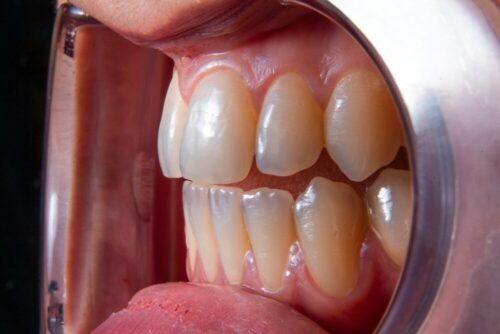 como arreglar dientes transparentes o translucidos