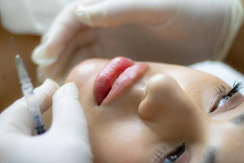 cuanto dura el acido hialuronico en los labios
