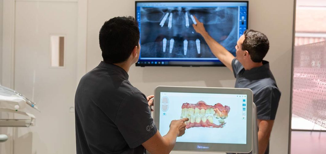implantes dentales all-on-4