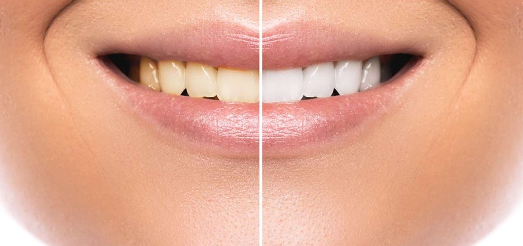 beneficios del blanqueamiento dental