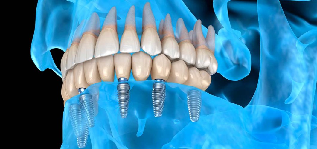 implantes dentales personalizados 3D