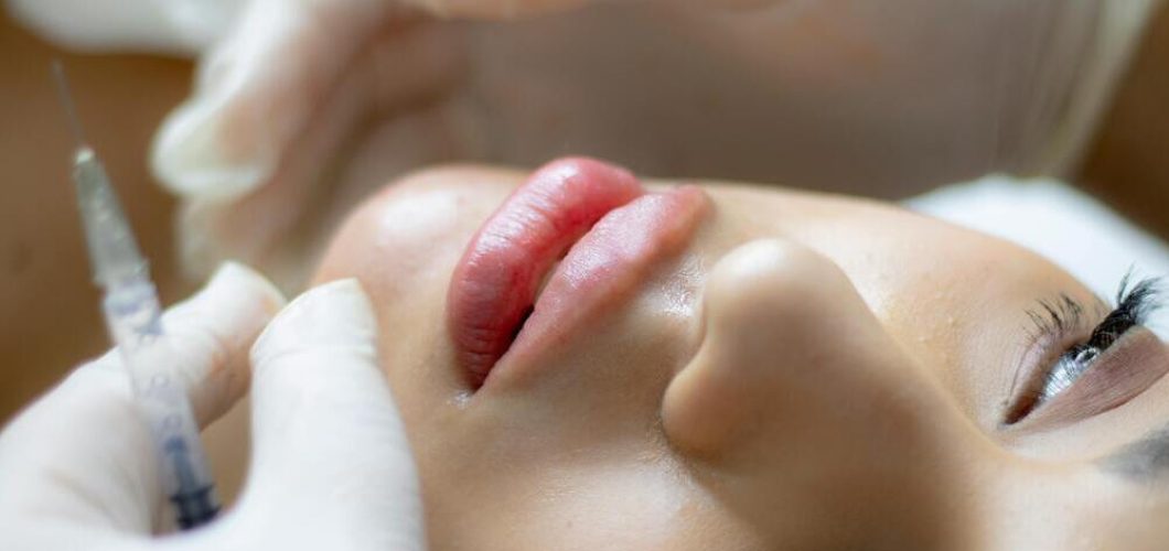 cuanto dura el acido hialuronico en los labios