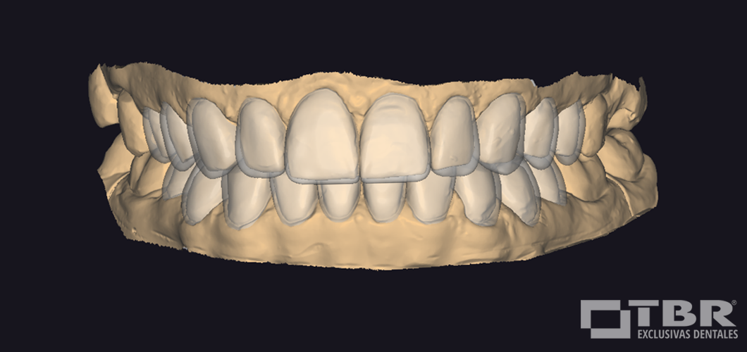 front-oclusion-trasp-web