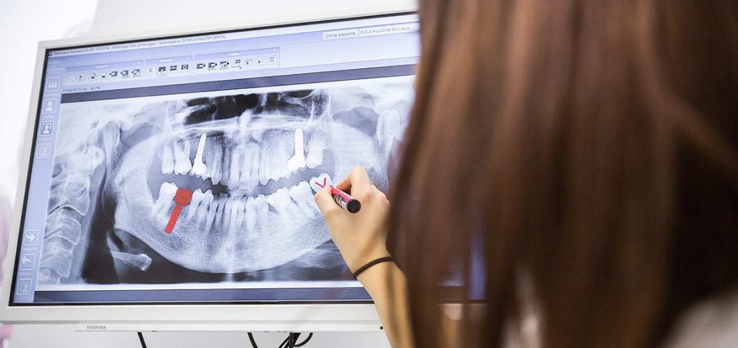 implantes dentales con osteoporosis