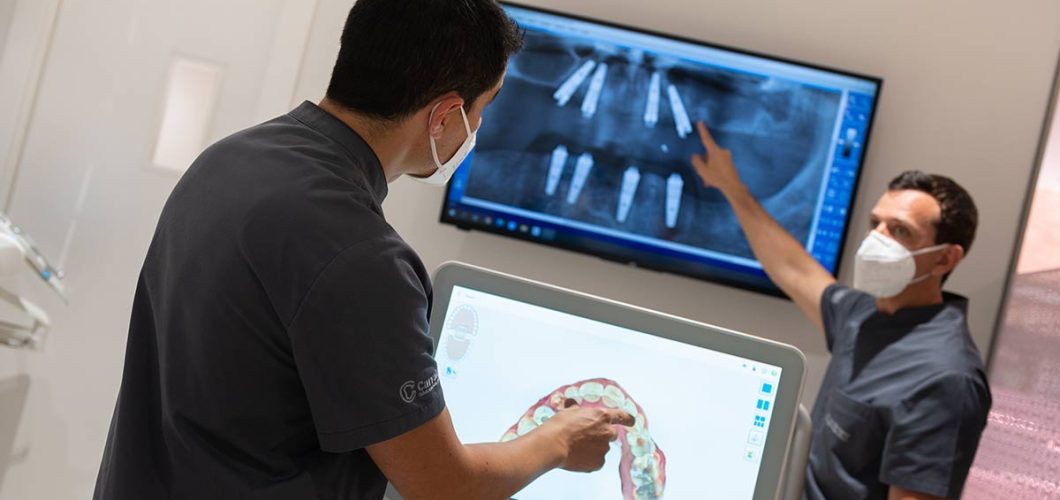 implantes dentales de boca completa