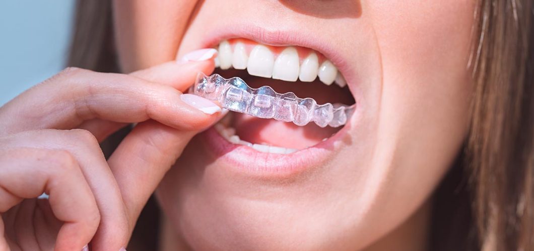 alineadores invisibles Invisalign