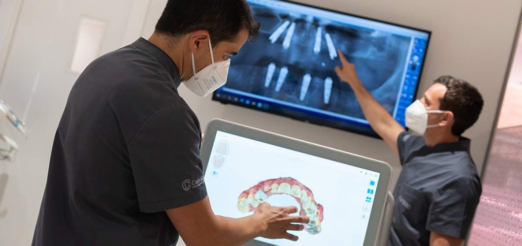 implantes de carga inmediata