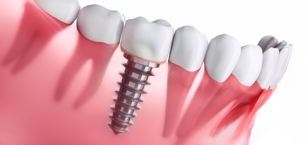 se me ha caido el tornillo del implante dental