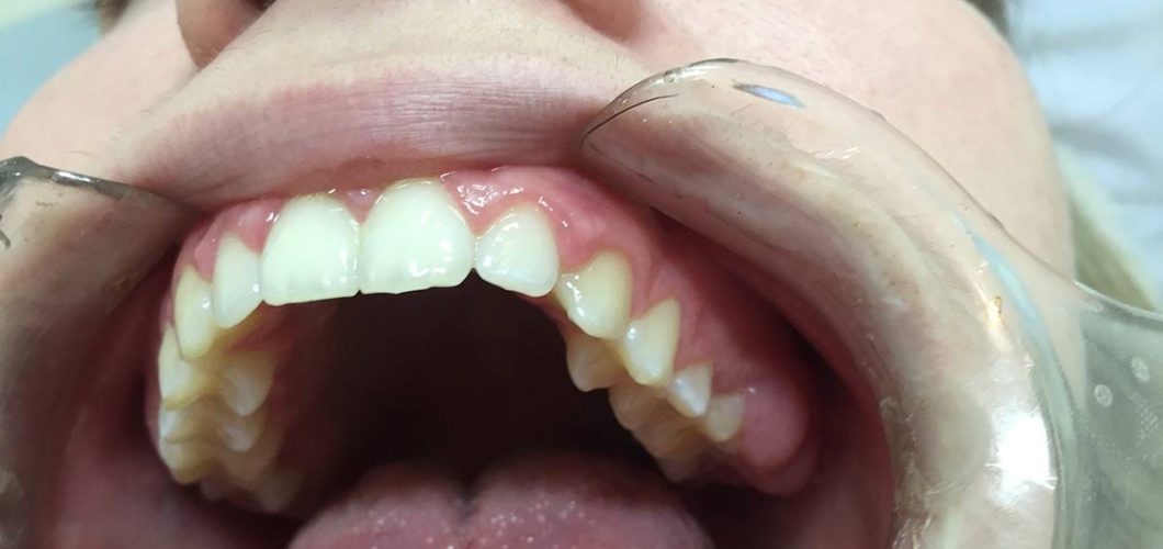 síntomas de la periodontitis