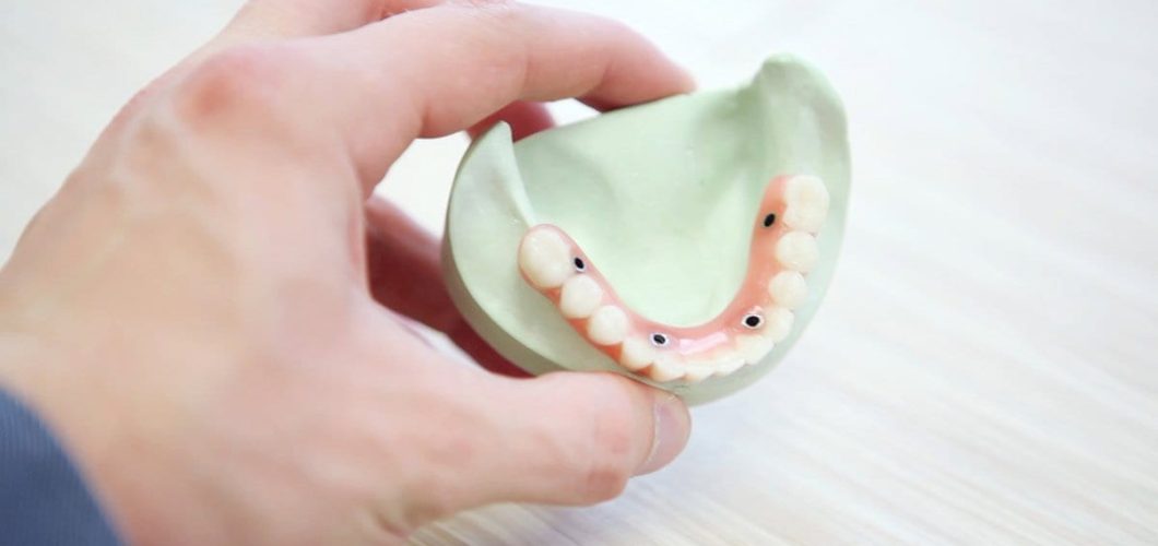 prótesis dentales fijas