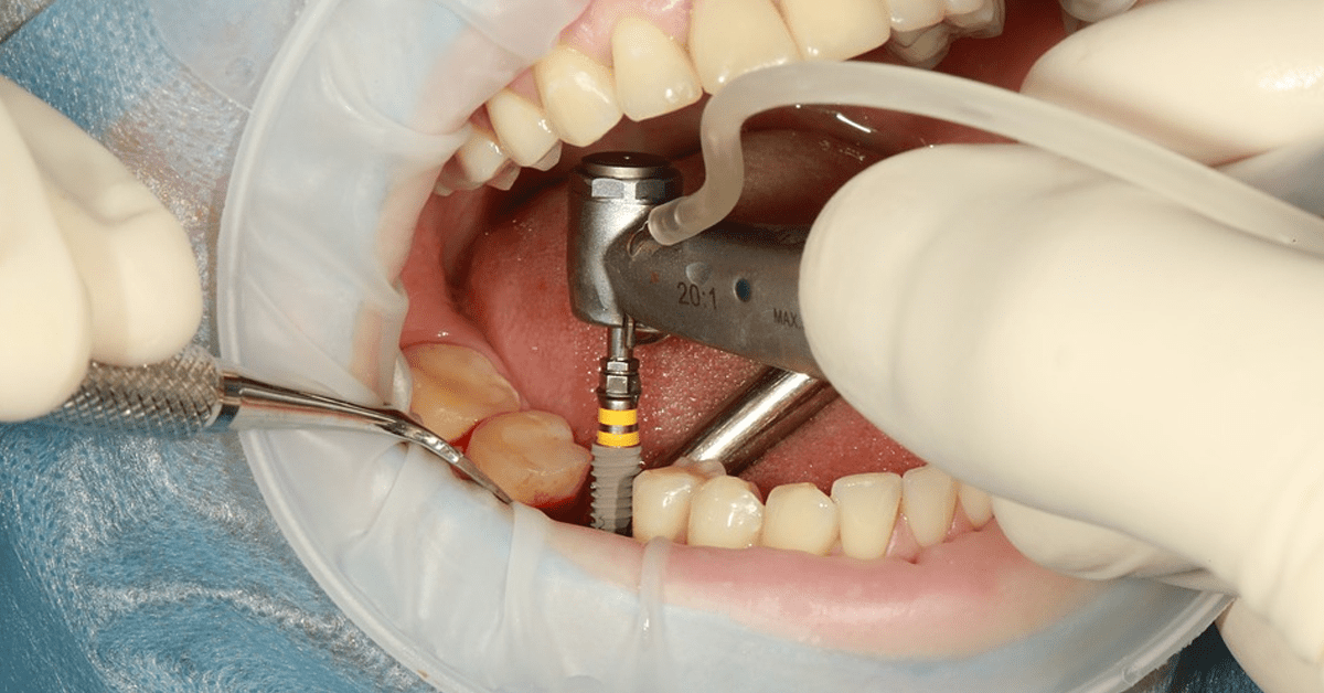 administrar Gallina encender un fuego Características y tipos de implantes dentales. Resolvemos dudas frecuentes  | Clínica Dental Carralero
