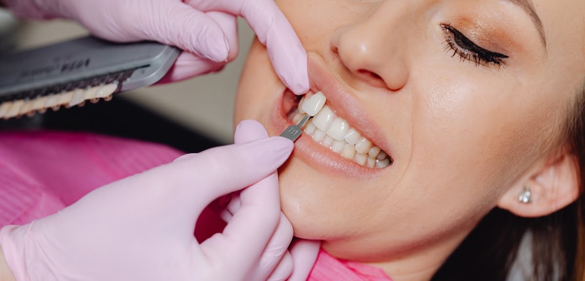 Carillas dentales: la solución estética