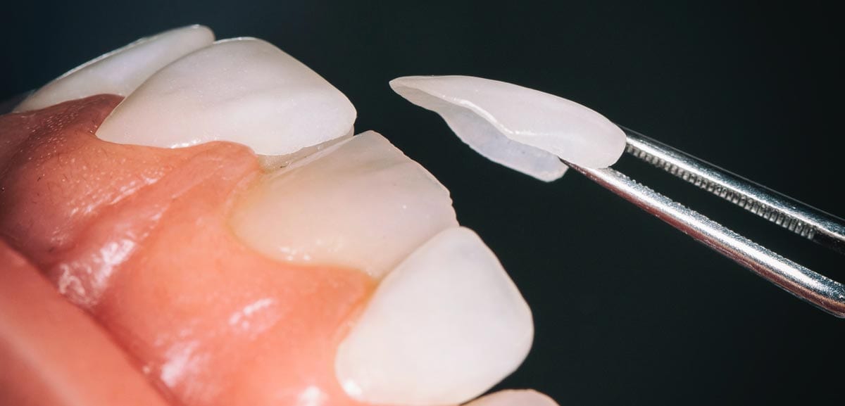 Por qué elegir las carillas dentales Lumineers Dental Carralero