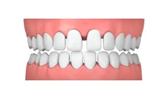 protusion-dental