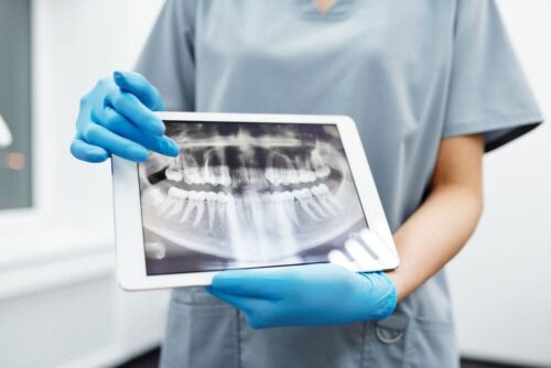 sintomas de perdida de hueso dental